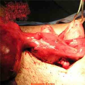 Endocrine Surgery for Prolapsed Uterus - Prolapsed Cervix download mp3 flac